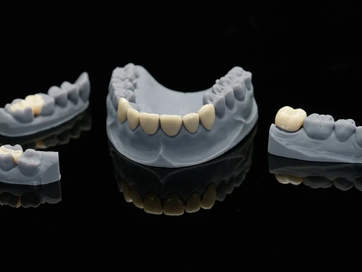 Carillas dentales de cerámica