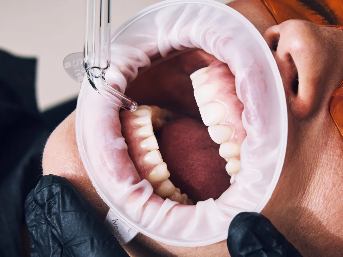 Aplicación de ozono médico en tratamiento dental