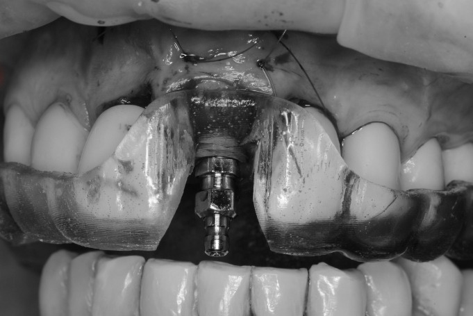 implantes dentales en jaen