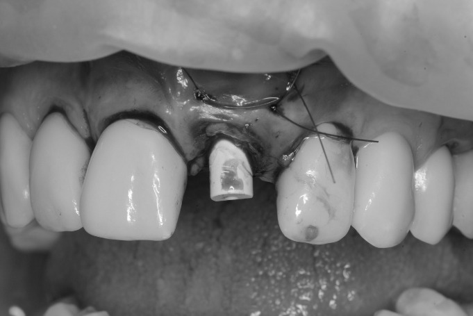 implantes dentales en jaen