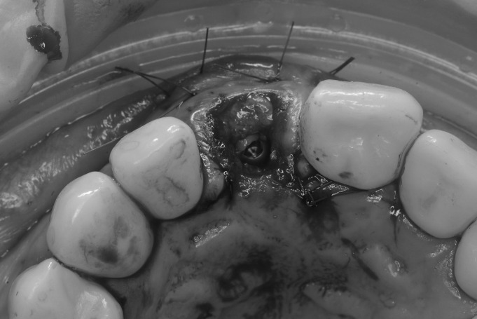 implantes dentales en jaen