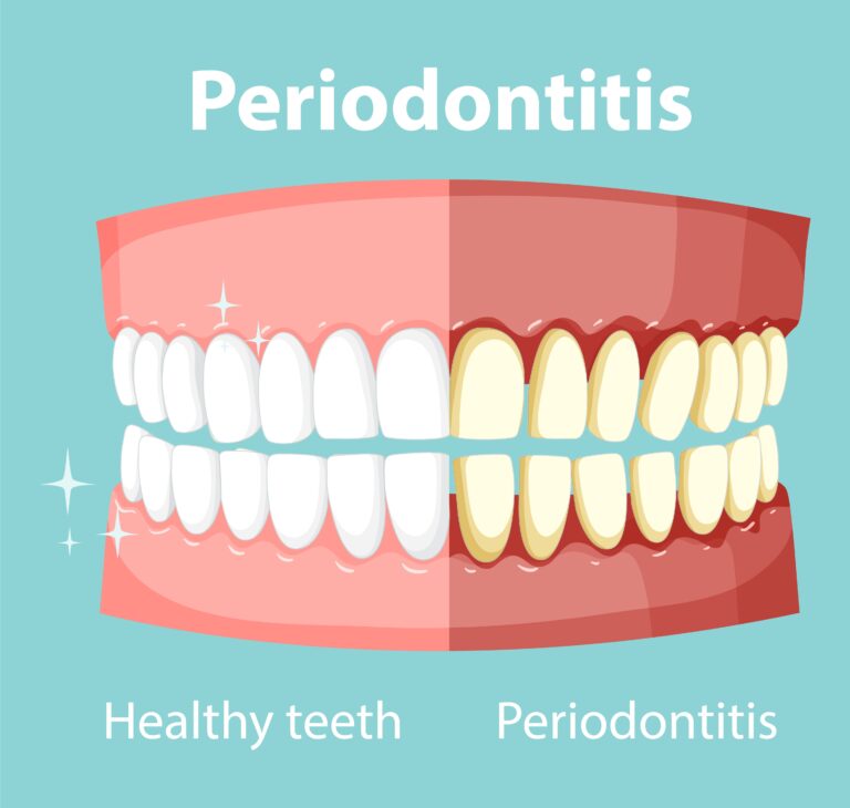 tratamiento cirugia periodoncia jaen